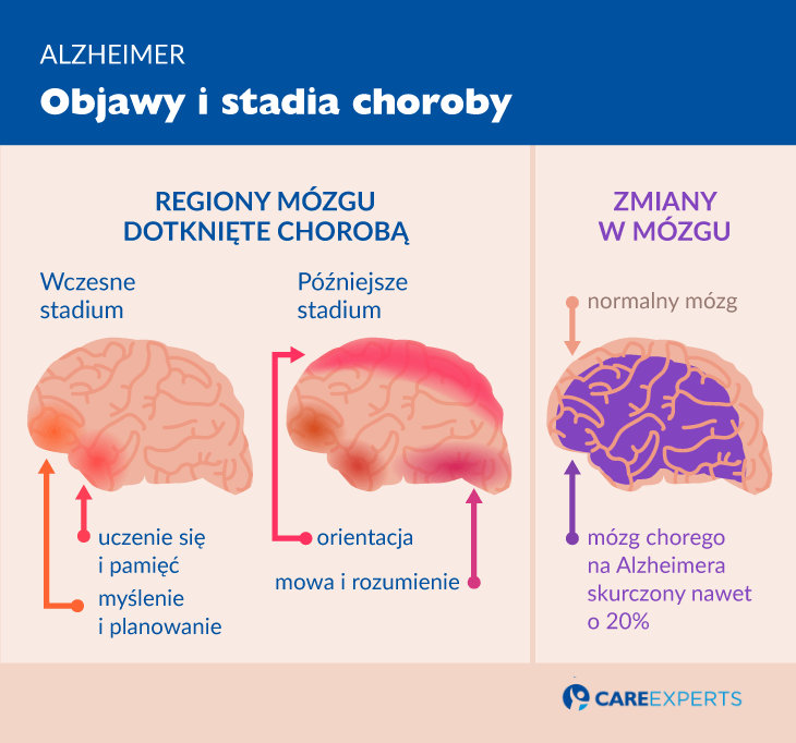 alzheimer objawy i stadia choroby